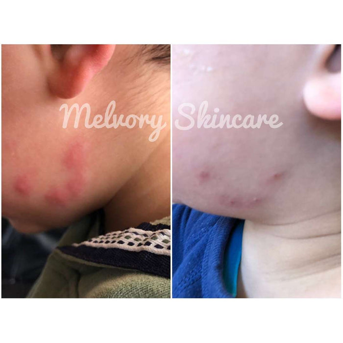 Melvory - MOZZIE BALM